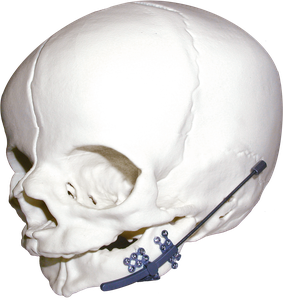 Logic™ Jr. Pediatric Mandibular Distraction System Product Image