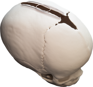 SmartFlex Pediatric Cranial Expander Product Image