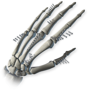 Hand Fusion System Product Image