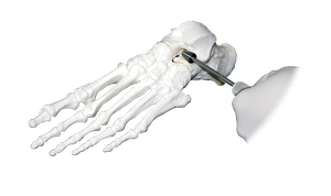 Talar-Fit™ Subtalar Arthroereisis Implant Product Image