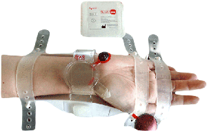 Syvek® Radial™ Hemostasis System Product Image